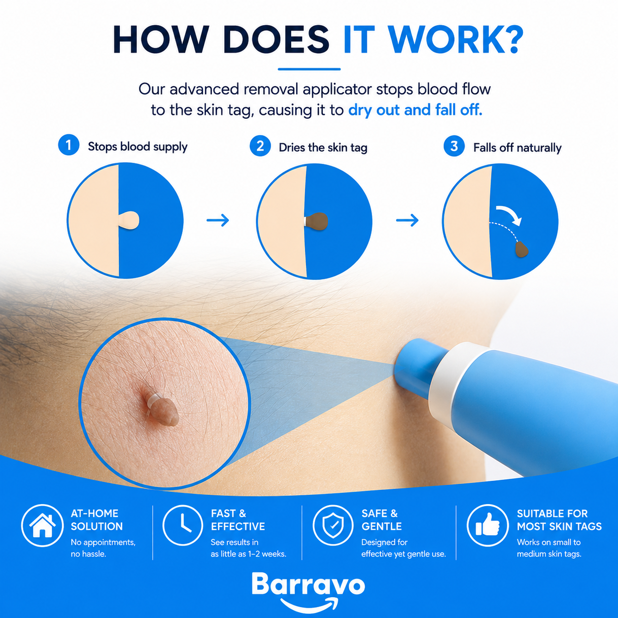 SkinAway | Simple Skin Tag Removal. From Home
