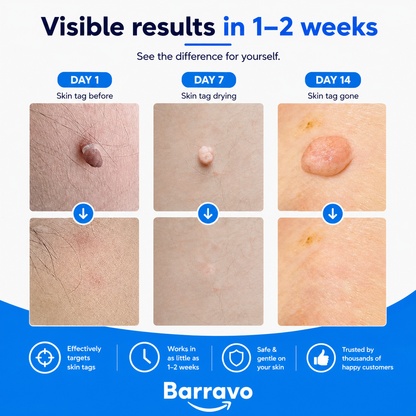 SkinAway | Simple Skin Tag Removal. From Home