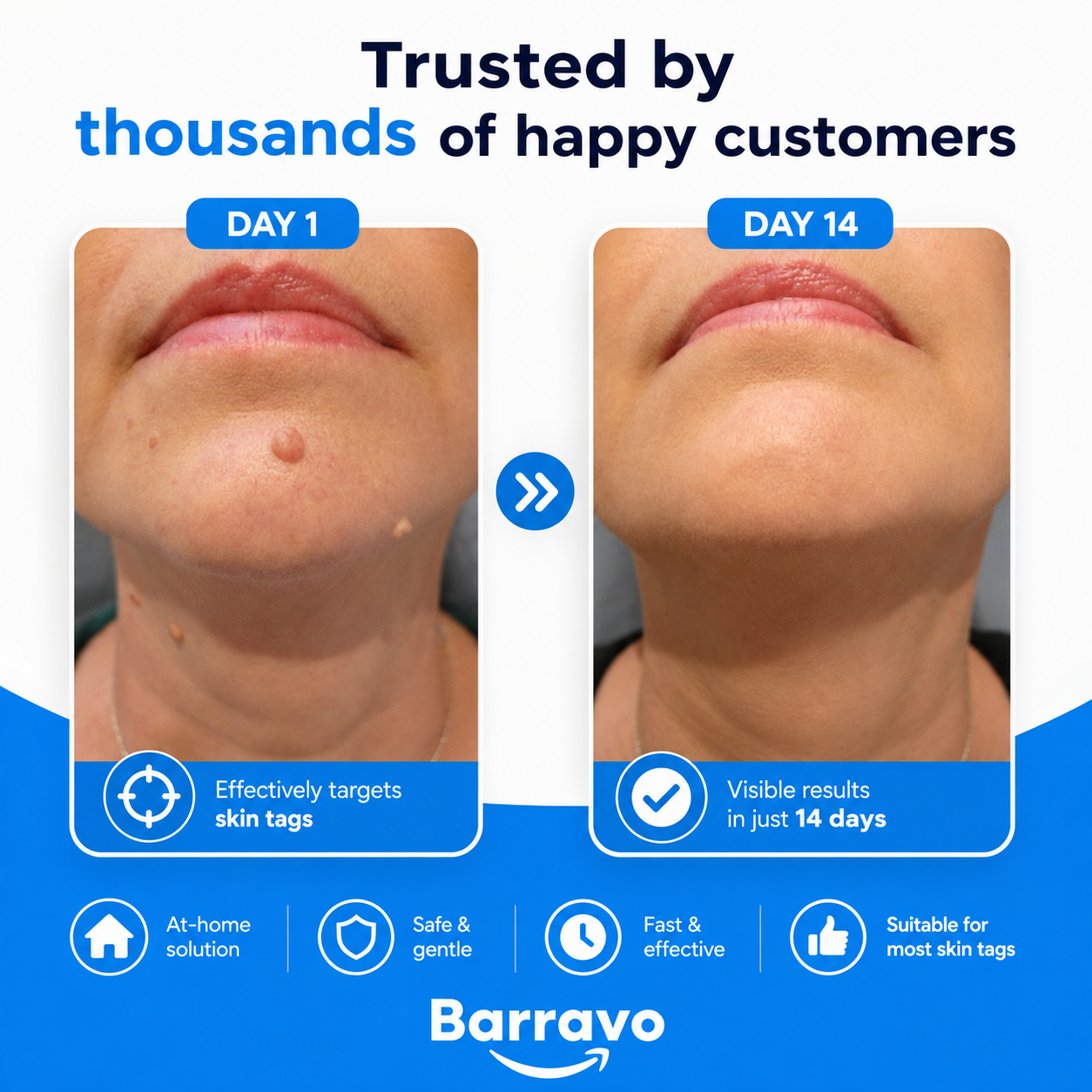 SkinAway | Simple Skin Tag Removal. From Home