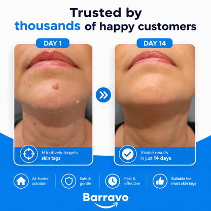 SkinAway | Simple Skin Tag Removal. From Home