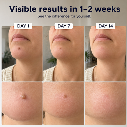 SkinAway | Simple Skin Tag Removal. From Home